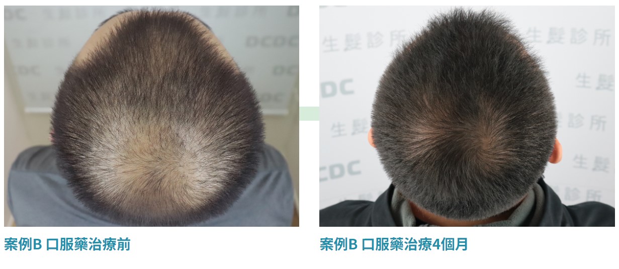 DCDC植髮診所專業雄性禿口服藥治療案例B